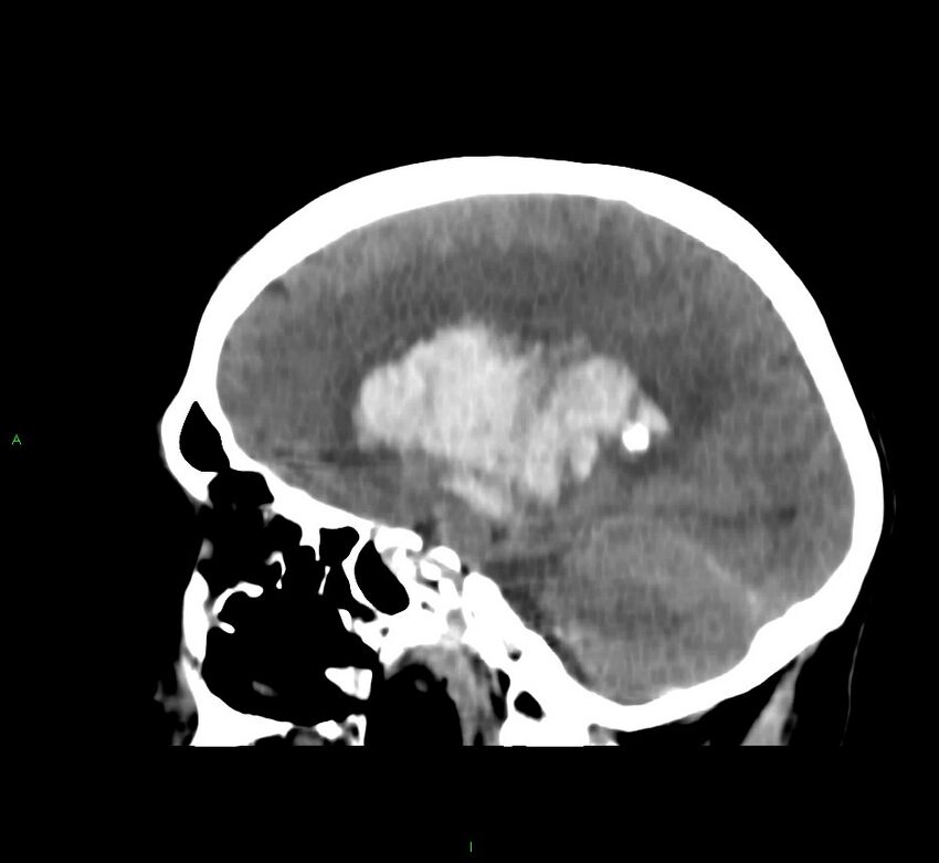 Basal ganglia hemorrhage (Radiopaedia 58767-65989 C 31).jpg