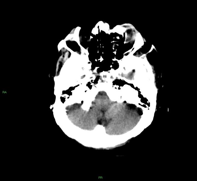 File:Basal ganglia hemorrhage (Radiopaedia 58790-66024 Axial non-contrast 38).jpg
