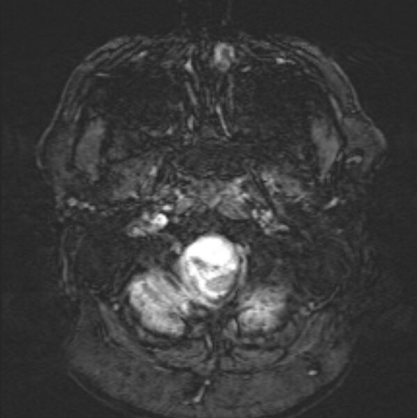 File:Basilar artery dissection (Radiopaedia 77032-88976 Axial SWI 4).jpg