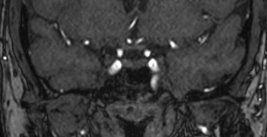 Basilar artery fenestration (Radiopaedia 74537-85455 Coronal MRA TOF 5).jpg