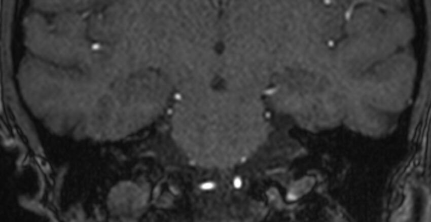 Basilar artery fenestration (Radiopaedia 74537-85455 Coronal MRA TOF 65).jpg