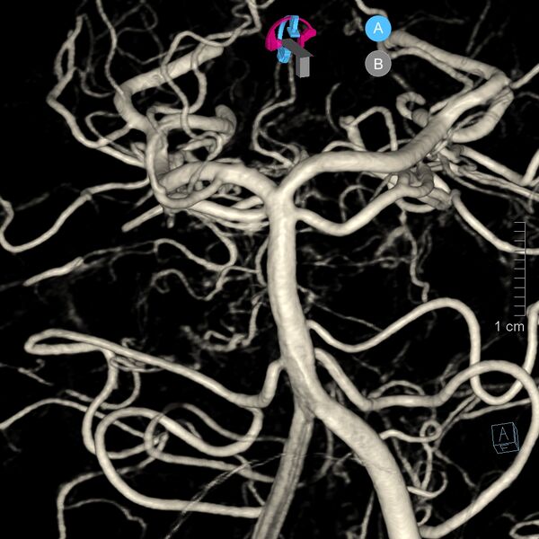 File:Basilar artery perforator aneurysm (Radiopaedia 82455-97734 3D view left VA 40).jpg