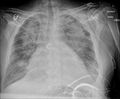 Bat wings - pulmonary edema (Radiopaedia 73144).jpg
