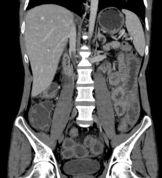 File:Behçet's disease- abdominal vasculitis (Radiopaedia 55955-62570 B 33).jpg