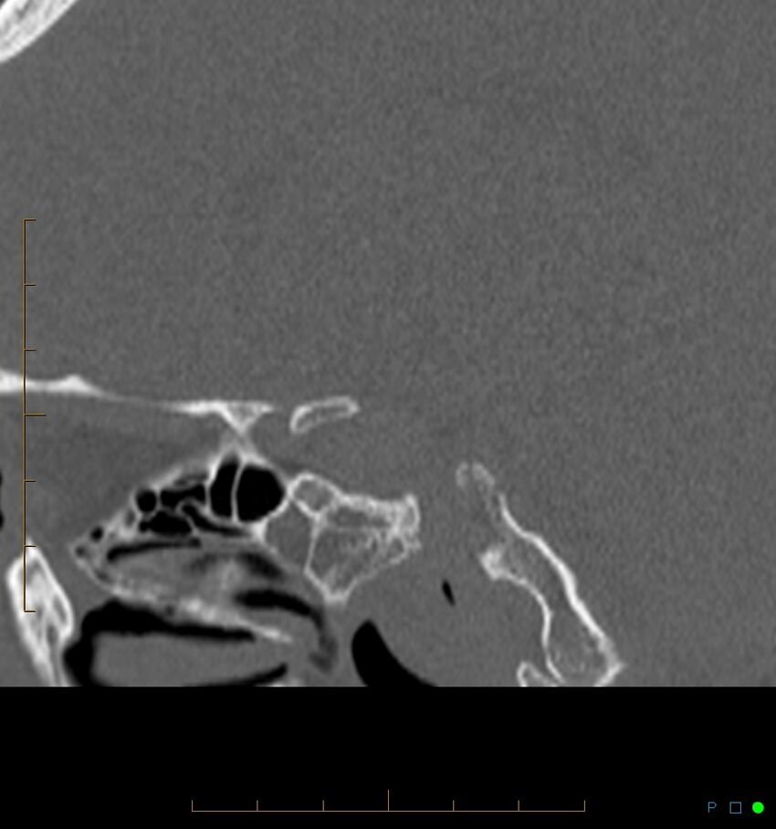 Benign notochordal cell tumor (probable) (Radiopaedia 65475-74546 Sagittal bone window 39).jpg