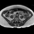 Bicornuate uterus (Radiopaedia 61974-70046 Axial T1 13).jpg
