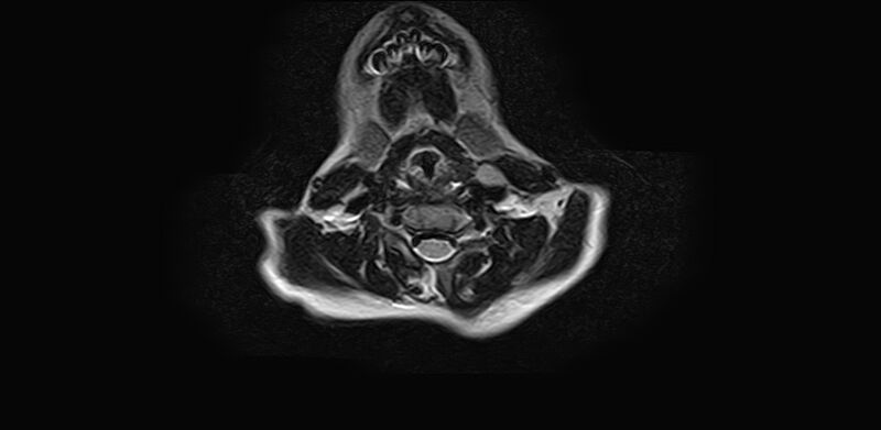 File:Bilateral Sprengel deformity with Klippel-Feil syndrome (Radiopaedia 66395-75650 Axial T2 13).jpg