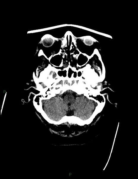 File:Bilateral acute middle cerebral artery territory infarcts (Radiopaedia 77319-89401 Axial non-contrast 13).jpg
