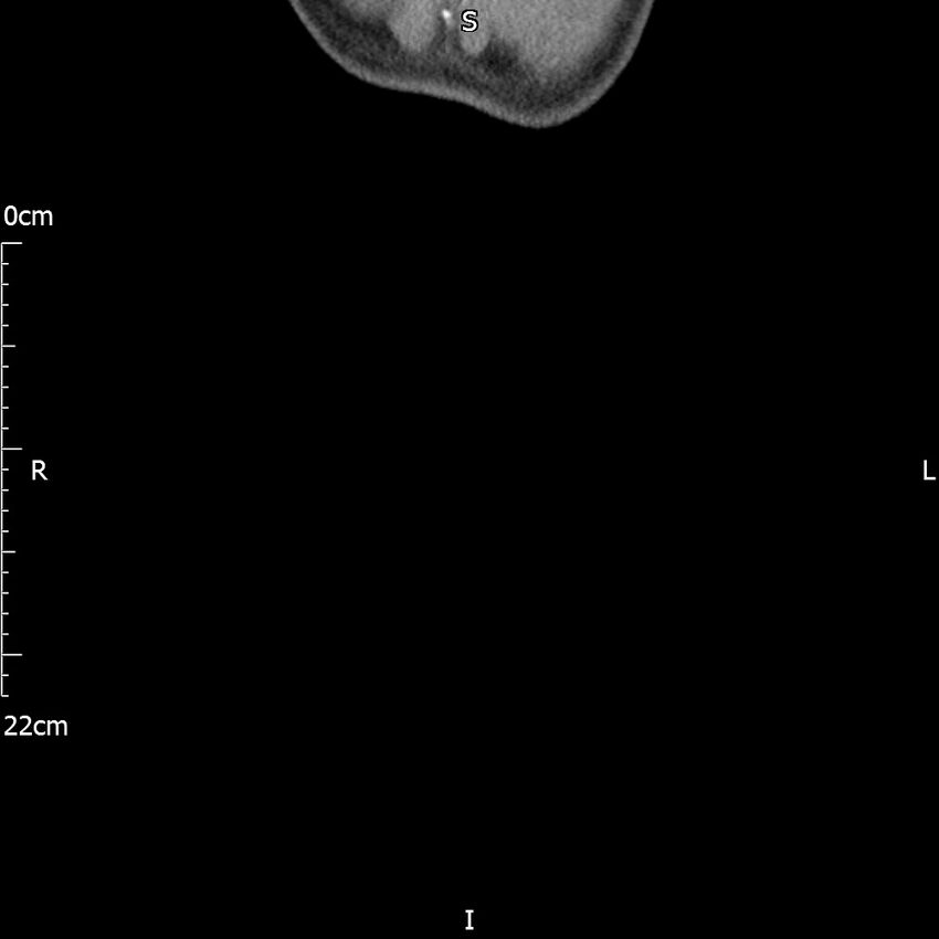 Bilateral medullary nephrocalcinosis with ureteric calculi (Radiopaedia 71269-81569 Coronal non-contrast 83).jpg