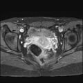 Bilateral ovarian endometriomas (Radiopaedia 87085-103347 Axial T1 C+ fat sat 14).jpg