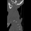 Bilateral perched facets with cord injury (Radiopaedia 45587-49713 Sagittal bone window 1).jpg