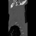 Bilateral perched facets with cord injury (Radiopaedia 45587-49713 Sagittal bone window 50).jpg
