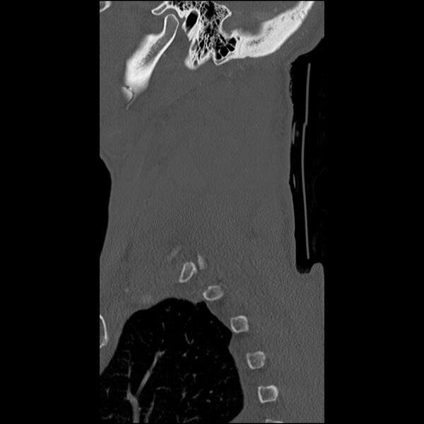 File:Bilateral perched facets with cord injury (Radiopaedia 45587-49713 Sagittal bone window 50).jpg