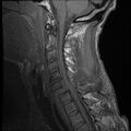 Bilateral perched facets with cord injury (Radiopaedia 45587-49714 Sagittal T1 7).jpg