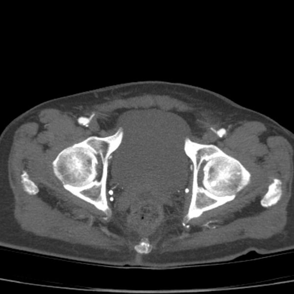 File:Bilateral superficial femoral arterial occlusion (Radiopaedia 25682-25857 A 25).jpg