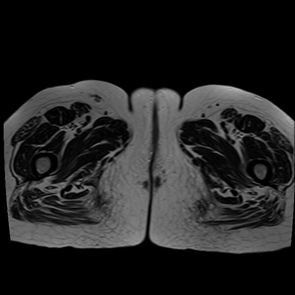 File:Bilateral tubo-ovarian abscesses (Radiopaedia 58635-65829 Axial T2 53).jpg