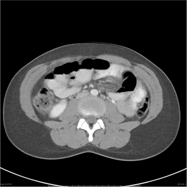 File:Bilateral ureteritis and cystitis (Radiopaedia 25340-25594 A 39).jpg