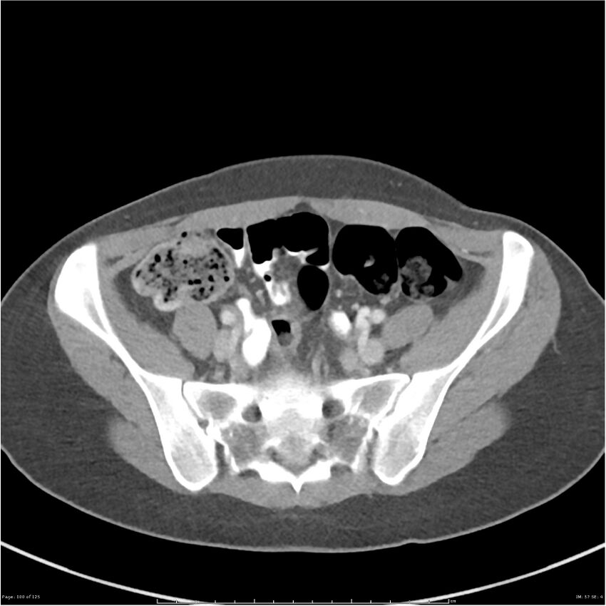 Bilateral ureteritis and cystitis (Radiopaedia 25340-25594 A 57).jpg