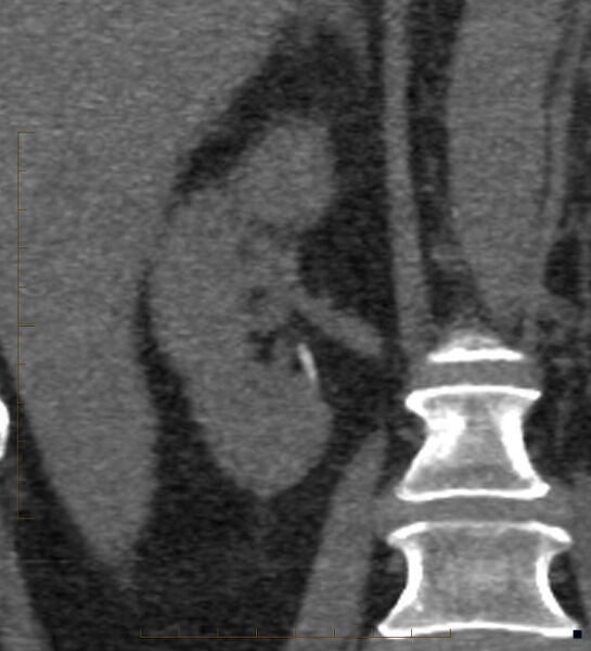 File:Bile leak from accessory duct(s) of Luschka post cholecystectomy (Radiopaedia 40736-43389 B 50).jpg