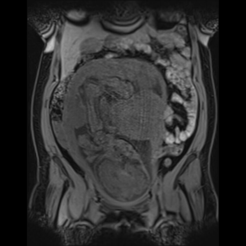 Bilobed placenta accreta (Radiopaedia 69648-79591 Coronal T1 vibe 76).jpg