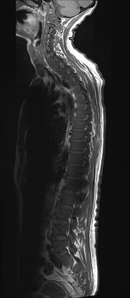File:Bing-Neel syndrome (Radiopaedia 71453-81799 Sagittal T1 11).jpg