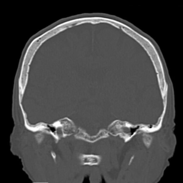 File:Biparietal osteodystrophy (Radiopaedia 46109-50463 Coronal bone window 57).jpg