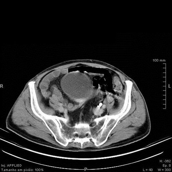 File:Bladder squamous cell carcinoma (Radiopaedia 14130-13984 C 2).jpg