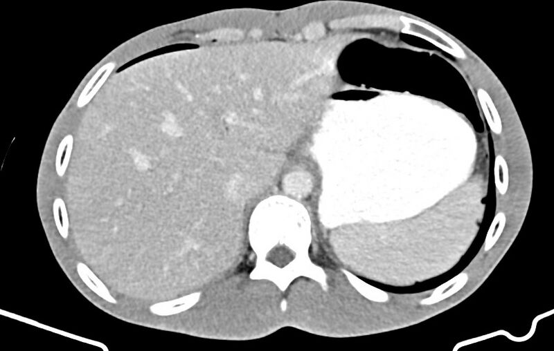 File:Blunt injury to the small bowel (Radiopaedia 74953-85987 A 15).jpg