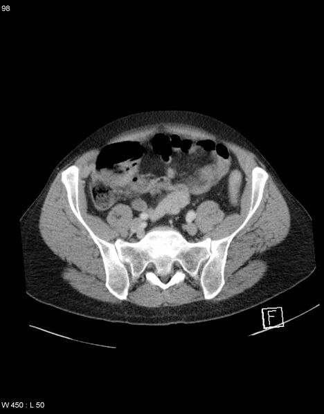 File:Boerhaave syndrome with tension pneumothorax (Radiopaedia 56794-63603 A 49).jpg