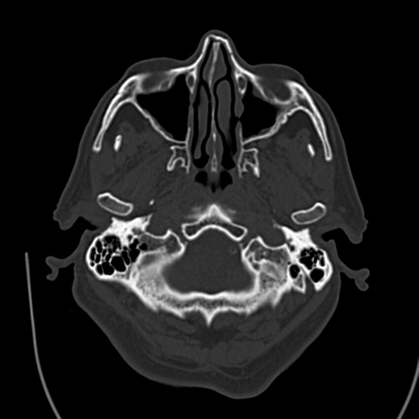 Brain Pantopaque remnants (Radiopaedia 78403-91048 Axial bone window 16).jpg