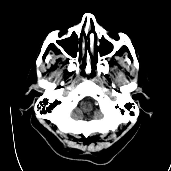 File:Brain Pantopaque remnants (Radiopaedia 78403-91048 Axial non-contrast 20).jpg