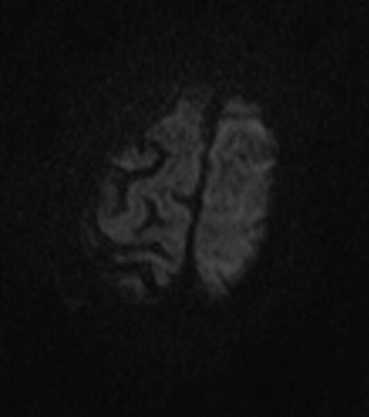 File:Brain abscess with dual rim sign (Radiopaedia 87566-103938 Axial DWI 18).jpg
