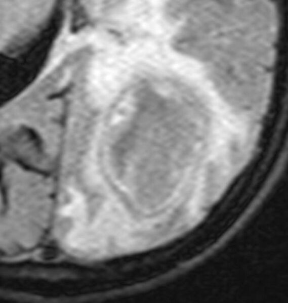 File:Brain abscess with dual rim sign (Radiopaedia 87566-103939 FLAIR 1).JPG