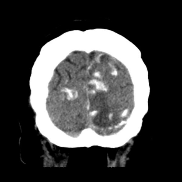 File:Brain cortical laminar necrosis (Radiopaedia 25822-25971 C 49).jpg