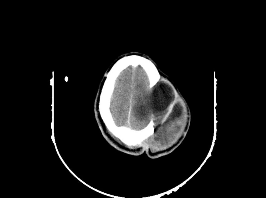 Brain injury by firearm projectile (Radiopaedia 82068-96088 A 181).jpg
