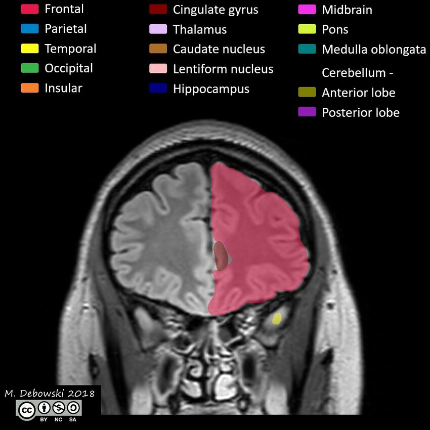 Brain lobes - annotated MRI (Radiopaedia 61691-69700 Coronal 16).JPG
