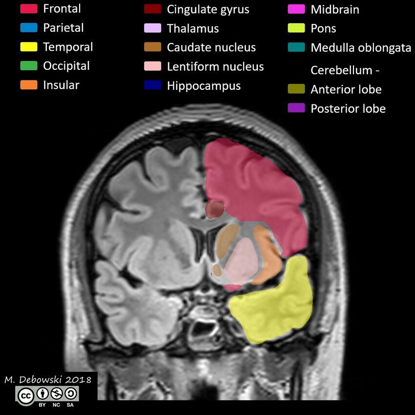 Brain lobes - annotated MRI (Radiopaedia 61691-69700 Coronal 27).JPG