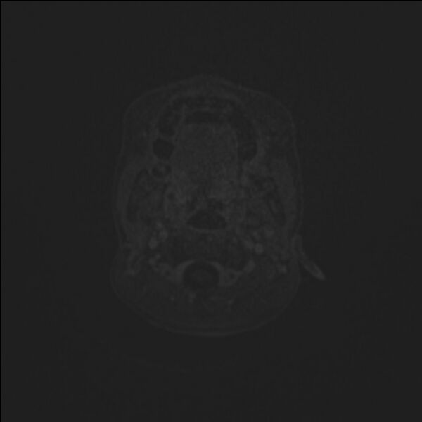 File:Brainstem glioma (Radiopaedia 70548-80674 Axial T1 C+ 2).jpg