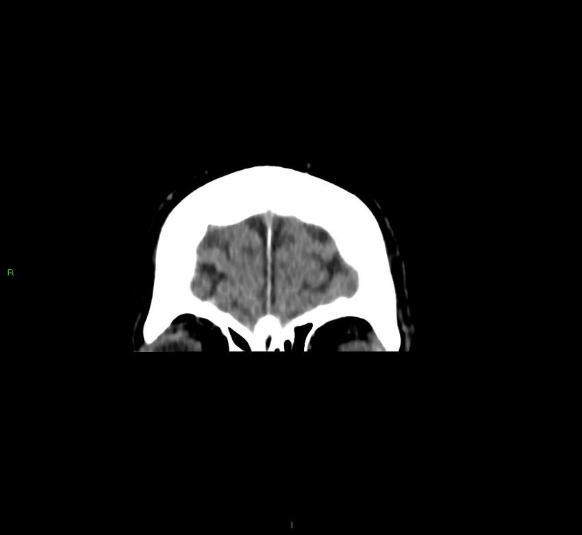 Brainstem hemorrhage (Radiopaedia 58794-66028 Coronal non-contrast 58).jpg