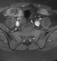 Broad ligament leiomyoma (Radiopaedia 81634-95516 Axial T1 C+ fat sat 2).jpg