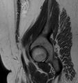 Broad ligament leiomyoma (Radiopaedia 81634-95516 Sagittal T2 2).jpg