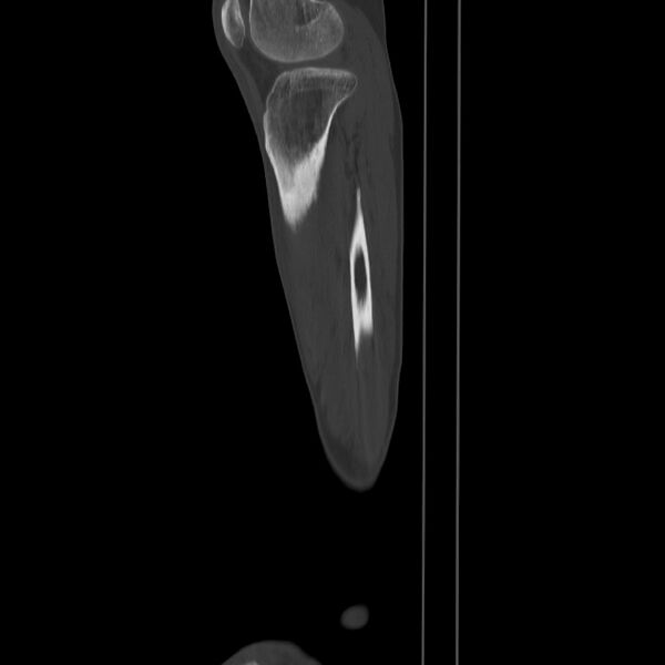 File:Brodie abscess - tibia (Radiopaedia 66028-75204 Sagittal bone window 62).jpg