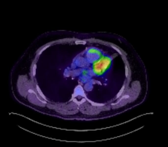 File:Bronchial carcinoid tumor (Radiopaedia 67377-76766 18FDG-PET-CT 27).jpg