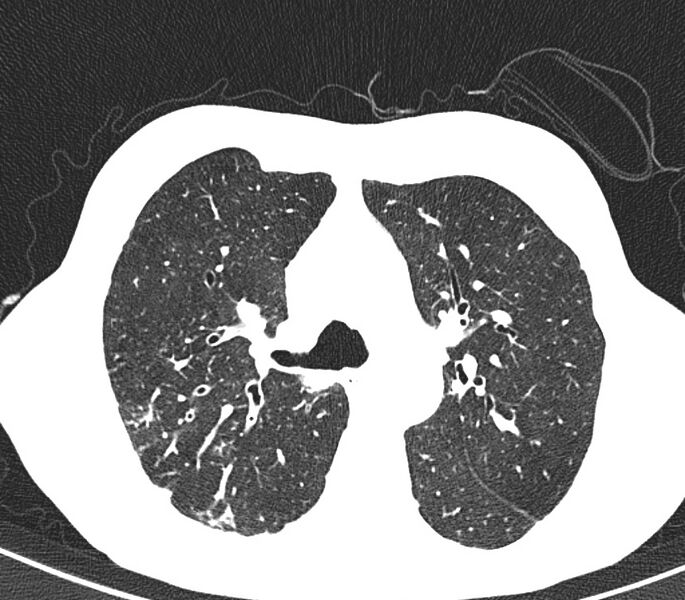 File:Bronchiolitis (Radiopaedia 24616-24887 Axial lung window 17).jpg