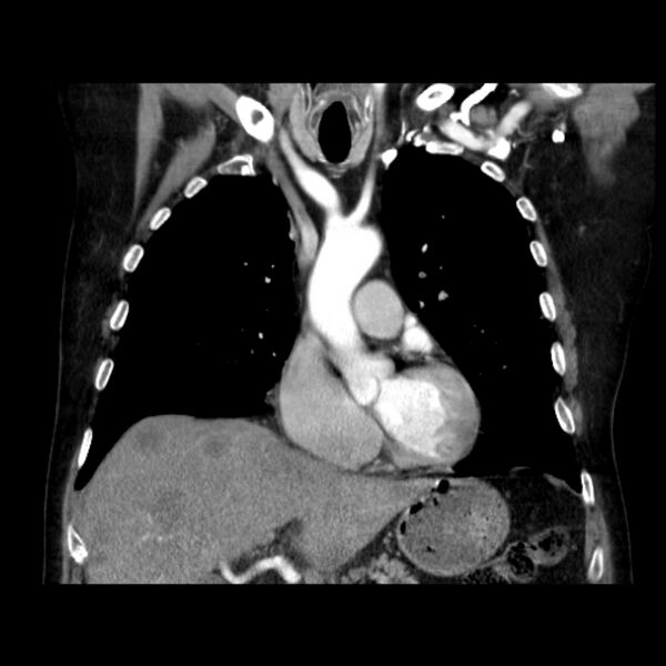 File:Bronchogenic adenocarcinoma and pulmonary embolism (Radiopaedia 9097-9806 C 19).jpg