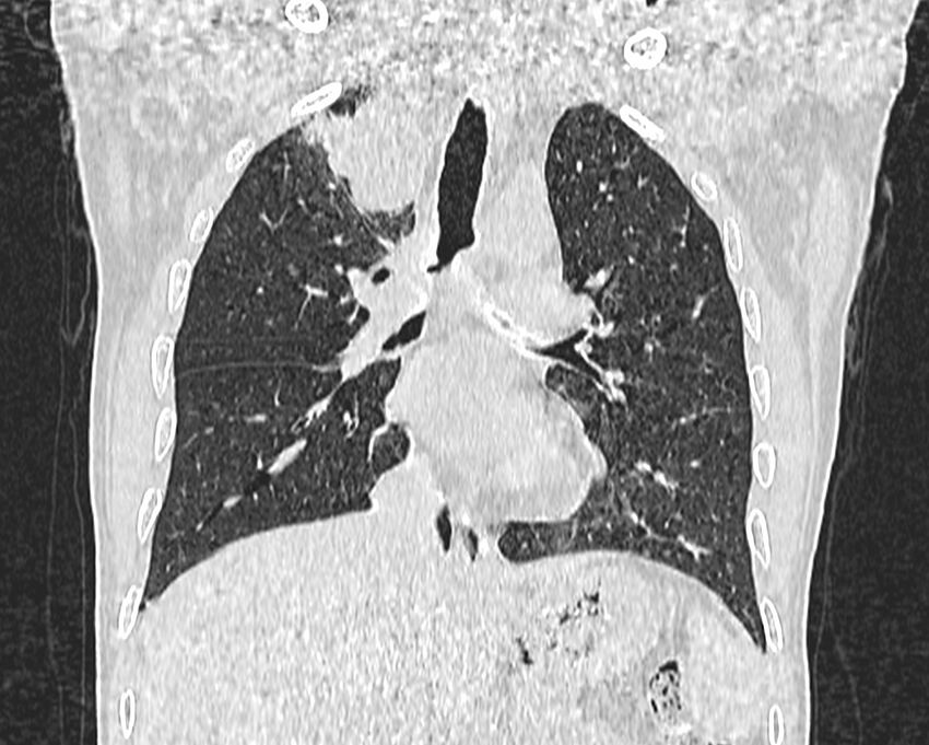 Bronchogenic carcinoma with superior vena cava syndrome (Radiopaedia 36497-38054 Coronal lung window 39).jpg