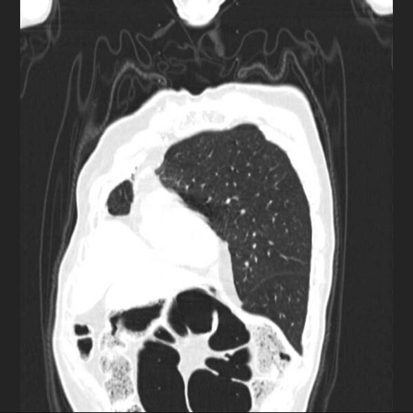 File:Bronchopleural fistula - postoperative complication (Radiopaedia 21020-20947 Coronal lung window 6).jpg