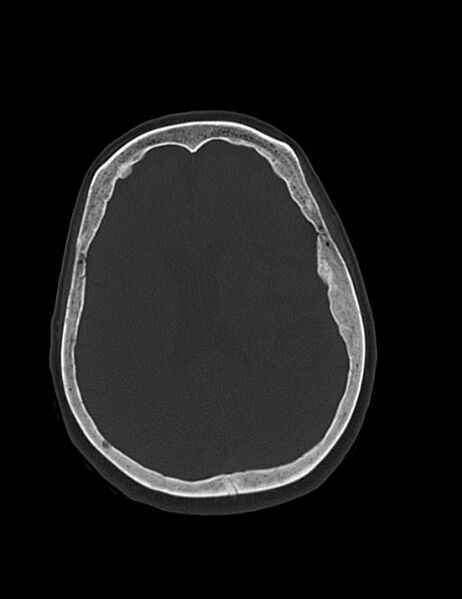 File:Burnt-out meningioma (Radiopaedia 51557-57337 Axial bone window 30).jpg