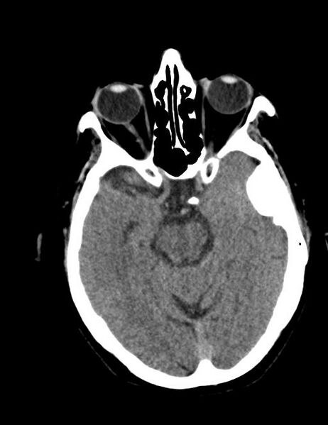 File:Burnt-out meningioma (Radiopaedia 51557-57337 Axial non-contrast 15).jpg