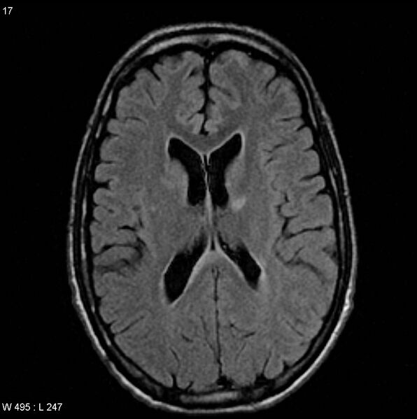 File:CMV ventriculitis and encephalitis (Radiopaedia 5416-7166 Axial FLAIR 5).jpg